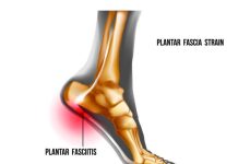 When Does Foot Numbness Require a Podiatric Evaluation? plantar fasciitis specialist